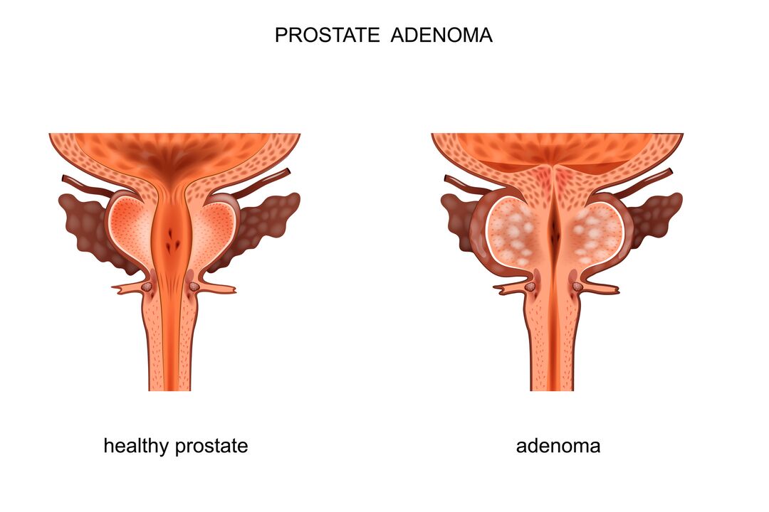 Egészséges prosztata és adenoma